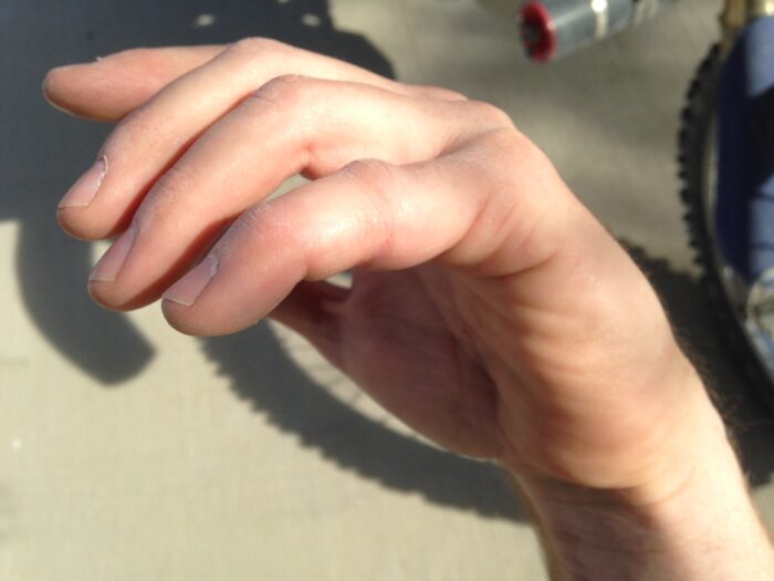Mike's hand with an obviously broken bone