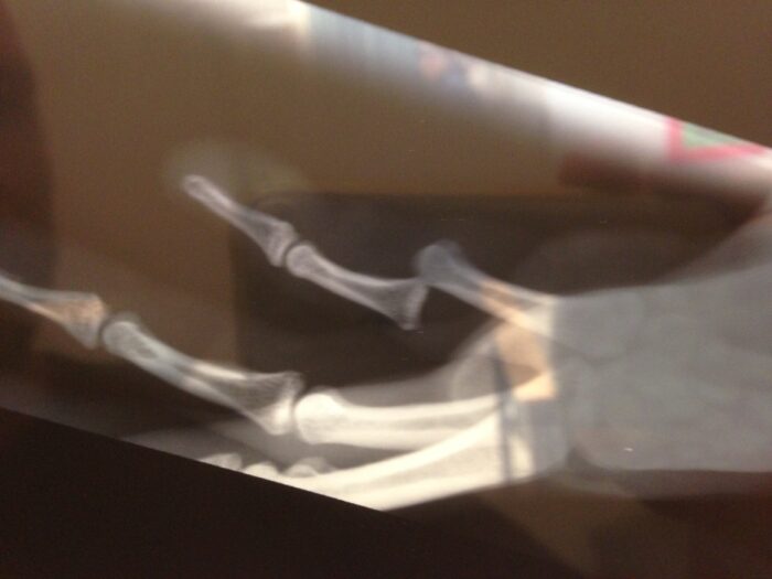X-ray of broken hand